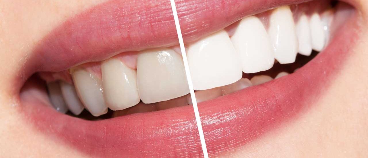 سفیدکردن دندانها در لبخندبرتر