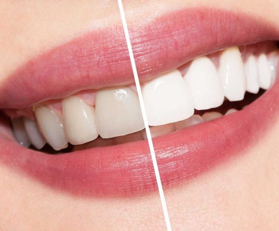 سفیدکردن دندانها در لبخندبرتر